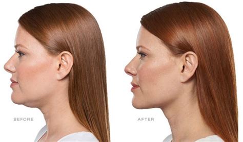 kybella pris